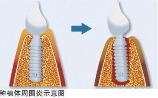 種植牙有什么風(fēng)險和后遺癥，可能導(dǎo)致神經(jīng)紊亂/牙齦萎縮