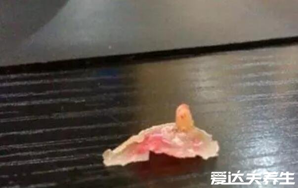 雞眼挖出來的根圖片，是淡黃色有針頭至黃豆大小的肉刺