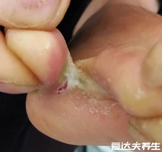 4種不同類型腳氣的圖片，腳部水皰或潰爛都可能是腳氣引起的