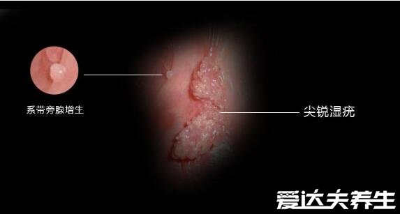 尖濕銳尤典型圖片，尖銳濕疣早期癥狀真假辨別