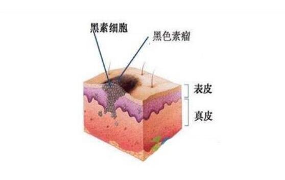 黑色素瘤早期癥狀圖片，通過(guò)abcd法輕松辨別普通痣和黑色素瘤