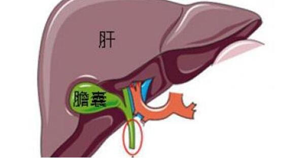 膽囊炎癥狀疼痛位置圖，右上腹右腰疼靠近肝臟區(qū)千萬別誤診了