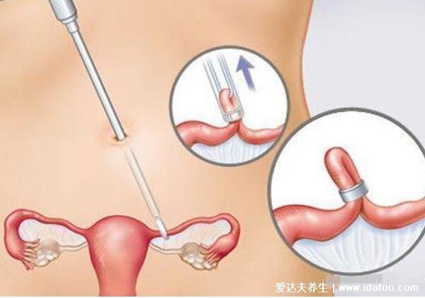 為什么不建議女人上環(huán)，可能會有的5大副作用(意外懷孕/墜痛)