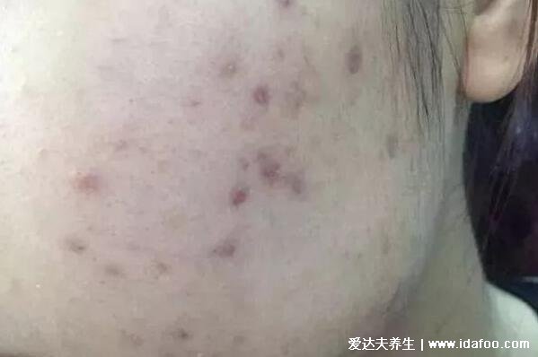 16個去除痘印的小妙招，白芷粉加蜂蜜敷臉淡斑祛痘印