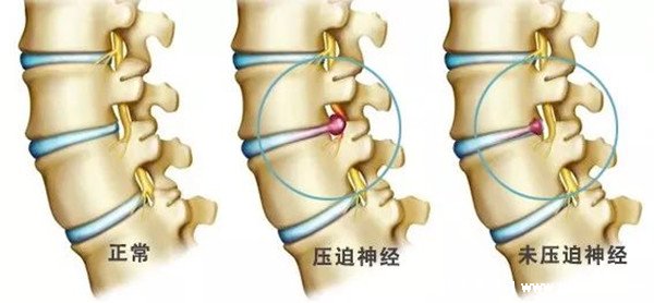 腎疼和腰疼的區(qū)別圖解圖片，腎疼在側(cè)腹腰疼在背部