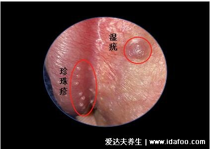 假疣和真疣的區(qū)別圖，不要把這兩個(gè)認(rèn)錯(cuò)了