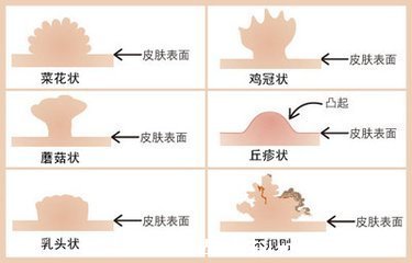 假疣和真疣的區(qū)別圖，不要把這兩個(gè)認(rèn)錯(cuò)了