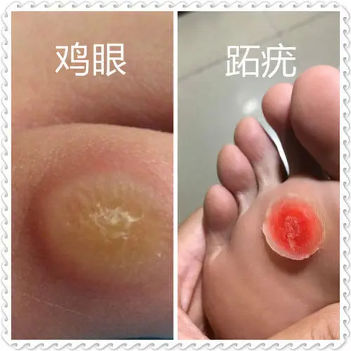 腳趾疣和雞眼區(qū)別圖片，怎么區(qū)分要看發(fā)病癥狀（前者會有小黑點)