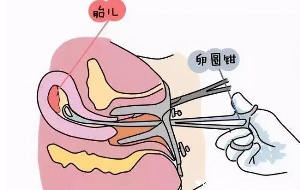 藥流10個人有9個流不干凈，不準(zhǔn)確但概率確實不低(附孕囊掉下來的圖片)