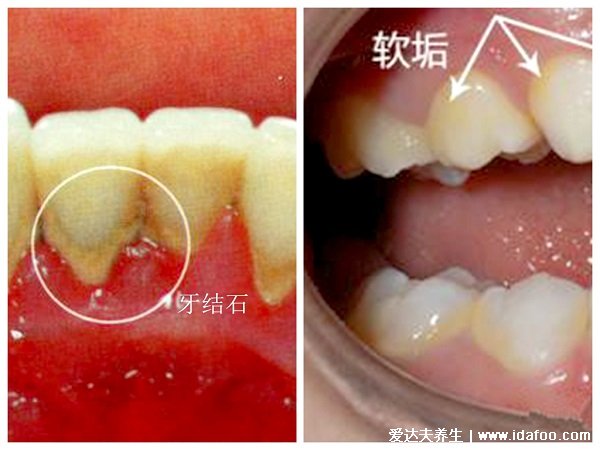 牙結(jié)石圖片可以自己摳掉嗎，牙齒表面是黃色黑色（不可以摳掉）