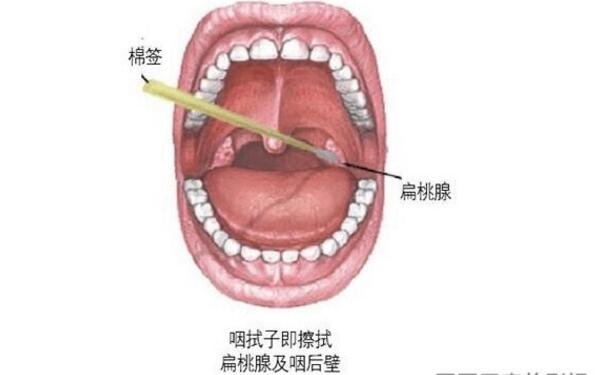 咽拭子采集的具體位置圖片，雙側(cè)咽扁桃體及咽后壁(示意圖)