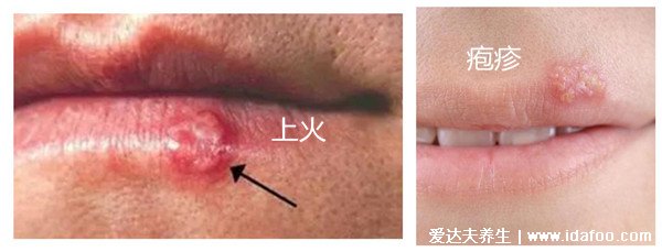 皰疹和上火水泡的區(qū)別圖片，小水泡密集是皰疹(上火水泡較大)