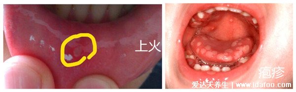 皰疹和上火水泡的區(qū)別圖片，小水泡密集是皰疹(上火水泡較大)