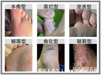 5種普通皮癬圖片早期癥狀，手蘚足蘚成人多見(jiàn)(甲蘚就是灰指甲)