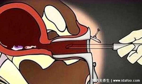 懷孕一個月怎么打掉最安全，49天內(nèi)且符合多種情況才能藥流