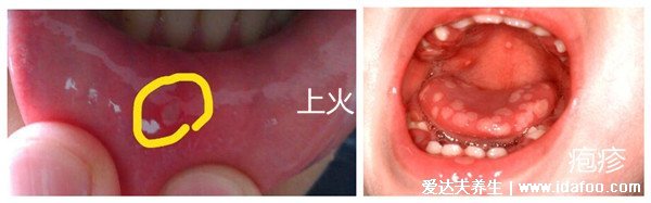 水泡和皰疹的區(qū)別圖片，皰疹會(huì)有身體癥狀(帶狀皰疹神經(jīng)痛)