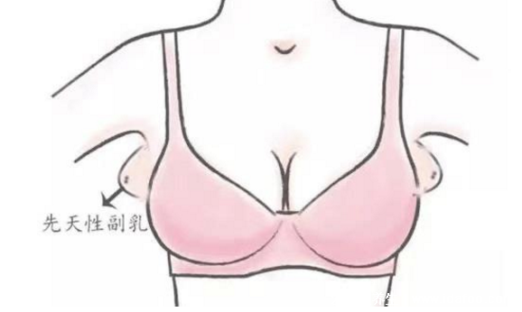 女人長副乳圖片，教你怎么判斷是副乳還是贅肉