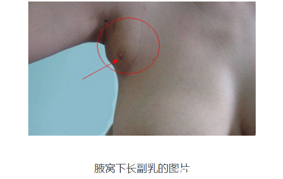 女人長副乳圖片，教你怎么判斷是副乳還是贅肉