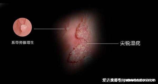 菜花狀疣體圖片早期癥狀，用什么藥要聽醫(yī)生建議(要注意尖銳濕疣)