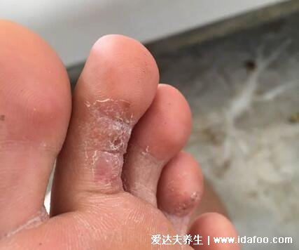 各種腳氣的癥狀圖片大全，水皰型最癢傳染性最強(qiáng)(附根治法)