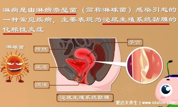 男女淋病的早期癥狀圖片真人圖，生殖器紅腫有膿性分泌物