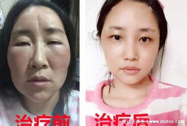 女性甲減最明顯的癥狀，不僅僅是容貌異常還會(huì)導(dǎo)致不孕