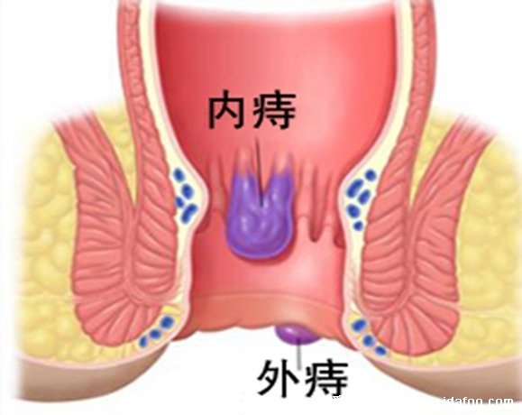 痔瘡長什么樣子的圖片，含內痔/外痔/混合痔圖片(混合痔主要發(fā)病形式)