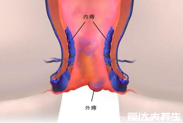 痔瘡長什么樣子的圖片，含內痔/外痔/混合痔圖片(混合痔主要發(fā)病形式)