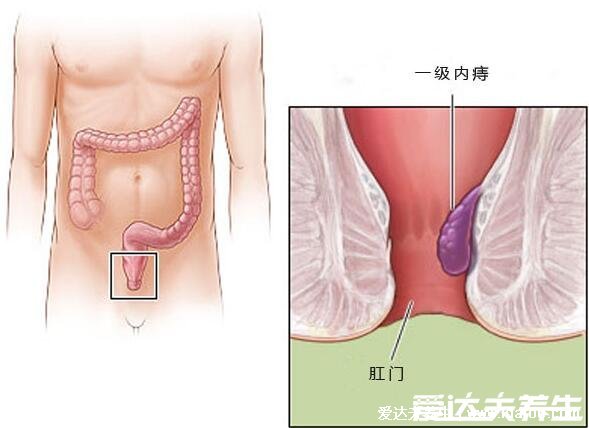 痔瘡長什么樣子的圖片，含內痔/外痔/混合痔圖片(混合痔主要發(fā)病形式)