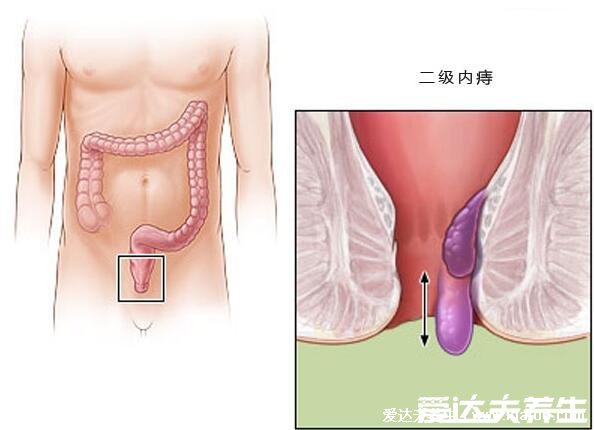 痔瘡長什么樣子的圖片，含內痔/外痔/混合痔圖片(混合痔主要發(fā)病形式)