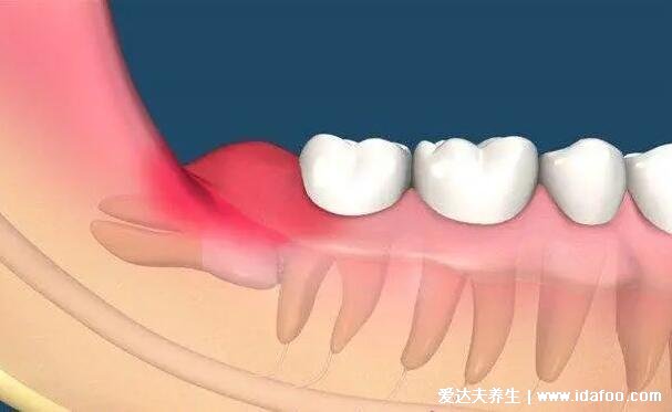 拔智齒后那個洞臭到惡心，拔牙后3-5天痛不欲生警惕干槽癥