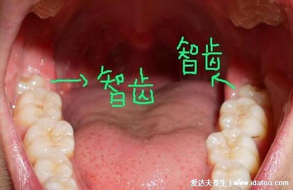 拔智齒后那個洞臭到惡心，拔牙后3-5天痛不欲生警惕干槽癥