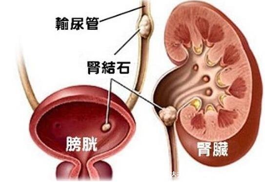 男女性腎結石會引起身體哪個部位疼痛圖片，在腰部也可在下腹疼