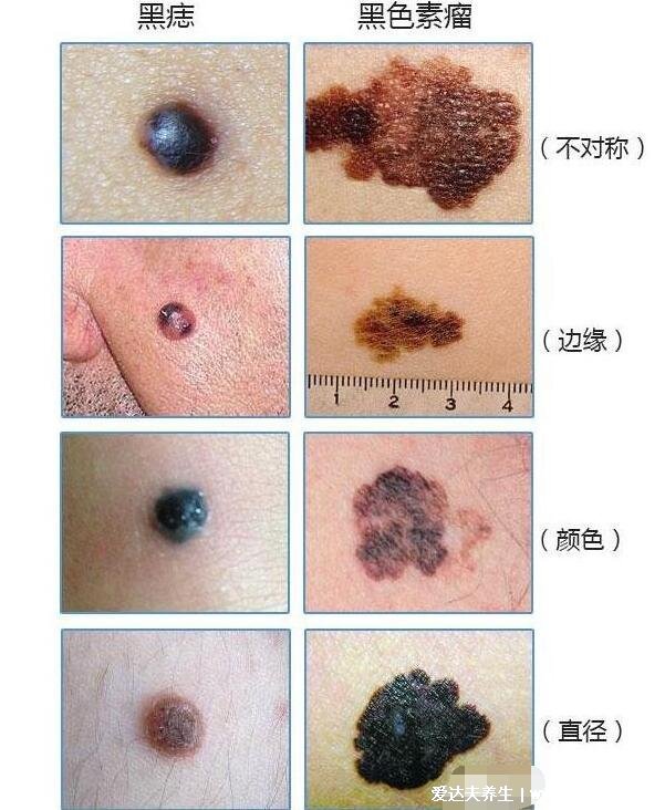 黑毛痣癌變前兆圖片，警惕痣的顏色改變且會流血瘙癢疼痛