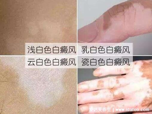 如何判斷白斑是不是白風(fēng)圖片，無皮屑顏色乳白日曬后灼痛