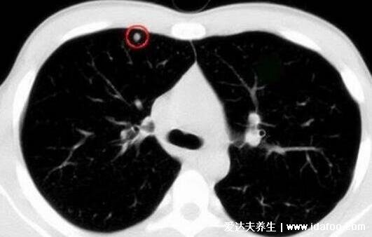 肺上結(jié)節(jié)80%是肺癌圖片，警惕生長(zhǎng)速度很快的結(jié)節(jié)(95%是良性)