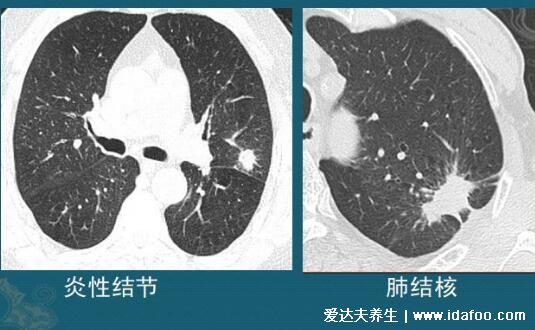 肺上結(jié)節(jié)80%是肺癌圖片，警惕生長(zhǎng)速度很快的結(jié)節(jié)(95%是良性)