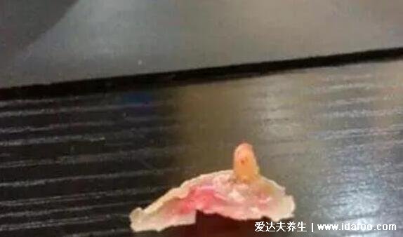 雞眼怎么治療自己脫落小妙招，除了用雞眼貼還有4個(gè)小偏方