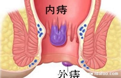 怎么讓痔瘡肉球縮回去小竅門，淡鹽水坐浴或熱水清洗(4個方法)