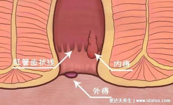 痔瘡24種圖片，肛門外有個(gè)肉疙瘩(外痔/內(nèi)痔/混合痔最嚴(yán)重)