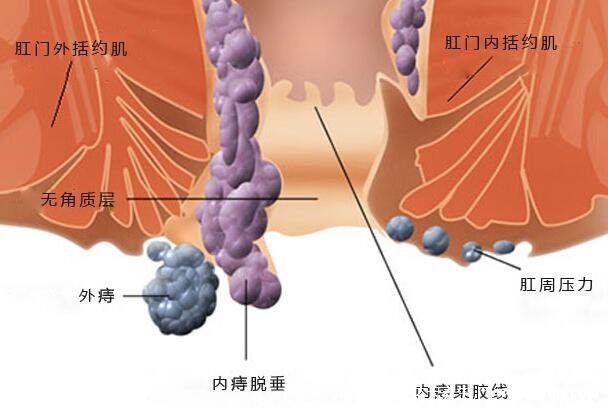 痔瘡24種圖片，肛門外有個(gè)肉疙瘩(外痔/內(nèi)痔/混合痔最嚴(yán)重)