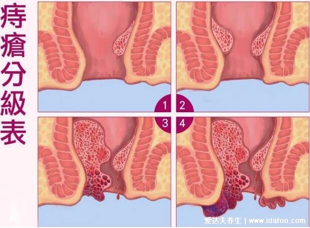 痔瘡24種圖片，肛門外有個(gè)肉疙瘩(外痔/內(nèi)痔/混合痔最嚴(yán)重)