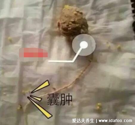 真人宮頸囊腫圖片大全，長(zhǎng)黃白色的囊泡伴隨白帶異常和痛經(jīng)