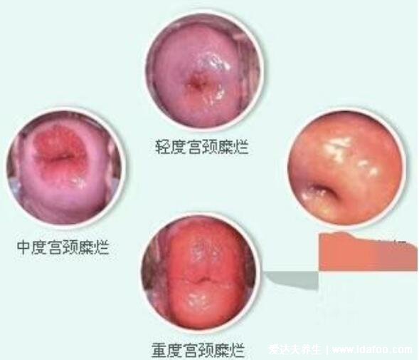 宮頸糜爛的圖片一二三度圖片，50歲女性宮頸糜爛有癌變可能