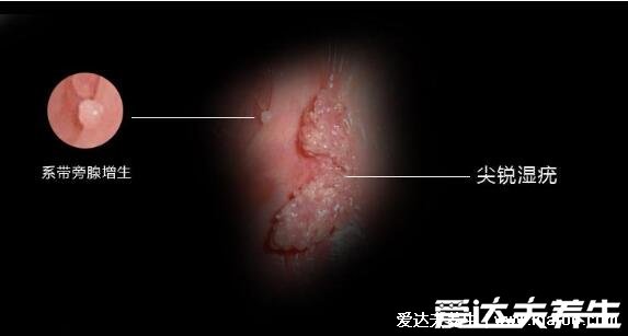 疣是什么樣子圖片，常見6種類型疣體(尋常疣/扁平疣/尖銳濕疣)