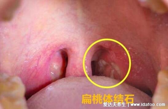 扁桃體結(jié)石脫落小妙招圖片，口腔里吐出了個(gè)小黃粒巨臭