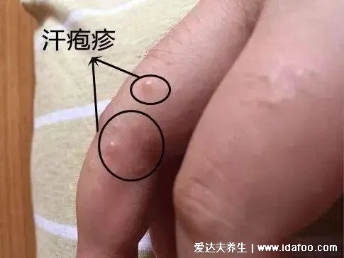 手上老是長“小水泡”，這是怎么回事？