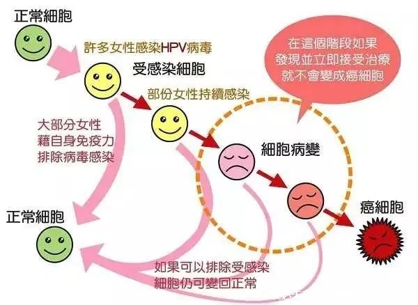 感染HPV病毒 就會(huì)惡變成宮頸癌嗎？造成宮頸癌的真正原因究竟是什么？