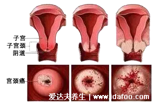 感染HPV病毒 就會(huì)惡變成宮頸癌嗎？造成宮頸癌的真正原因究竟是什么？