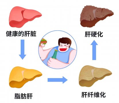 堅(jiān)持三個(gè)護(hù)肝秘訣，有效改善肥胖性脂肪肝對(duì)身體的危害